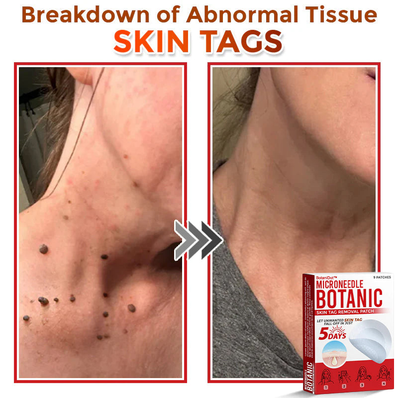 BotaniDot™ MicroNeedle Botanic Skin Tag Removal Patch 🇺🇸 Made in the USA