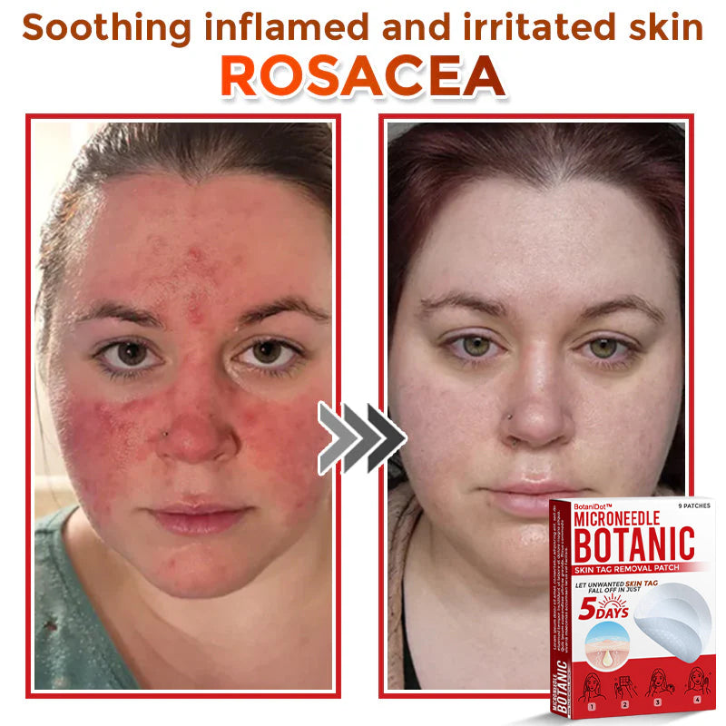 BotaniDot™ MicroNeedle Botanic Skin Tag Removal Patch 🇺🇸 Made in the USA
