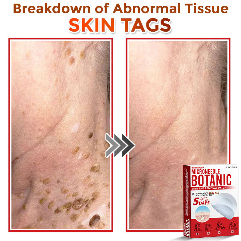 BotaniDot™ MicroNeedle Botanic Skin Tag Removal Patch 🇺🇸 Made in the USA