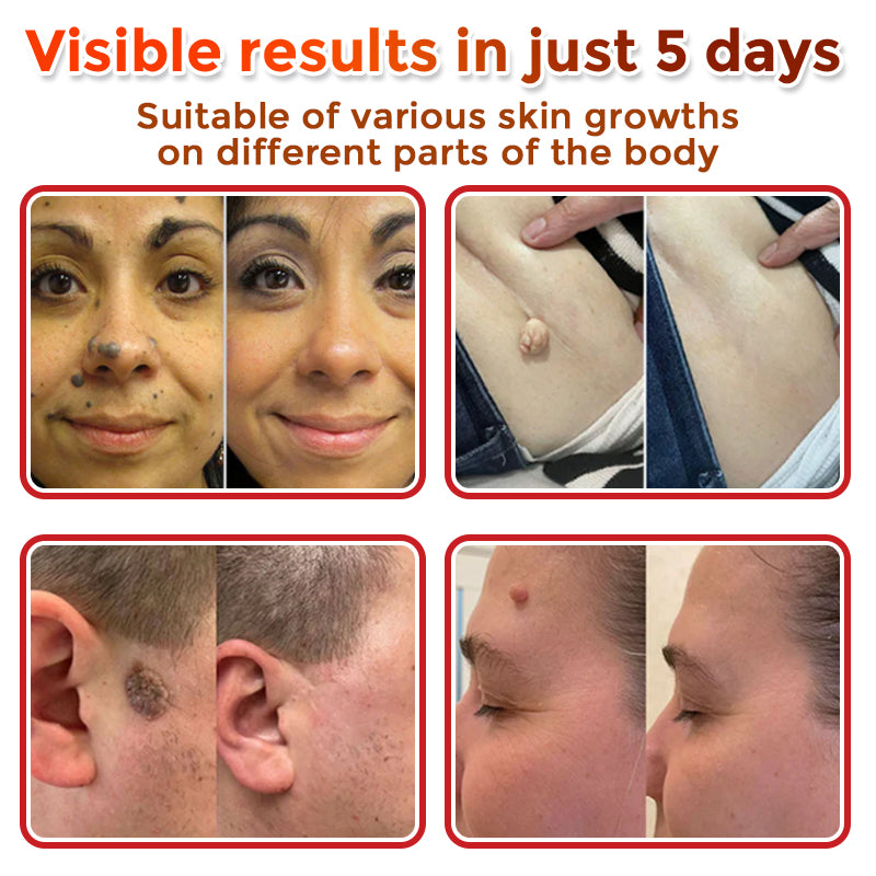 BotaniDot™ MicroNeedle Botanic Skin Tag Removal Patch 🇺🇸 Made in the USA