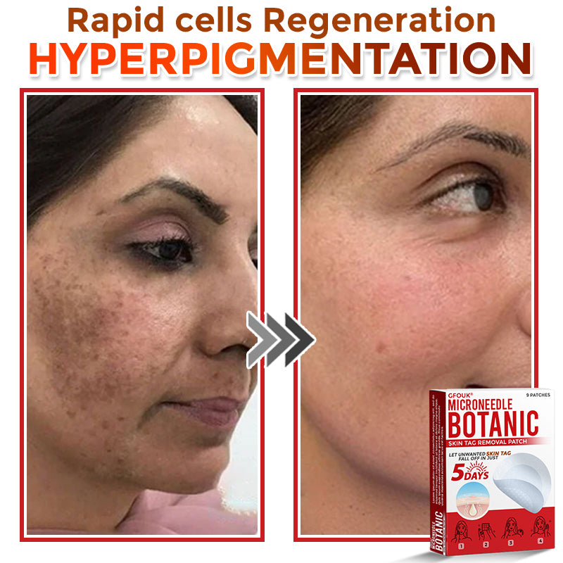 BotaniDot™ MicroNeedle Botanic Skin Tag Removal Patch 🇺🇸 Made in the USA