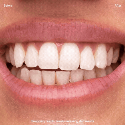 Whitening Strips