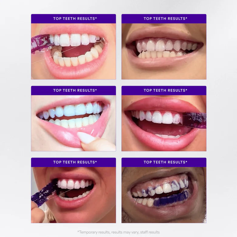 Whitening Strips